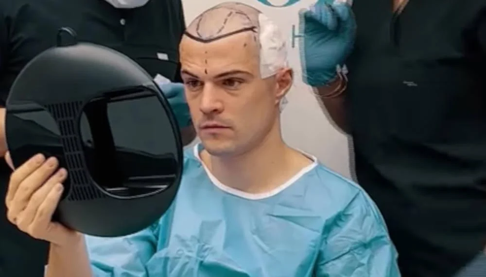 Granit Xhaka lässt Haartransplantation im Kosovo vornehmen